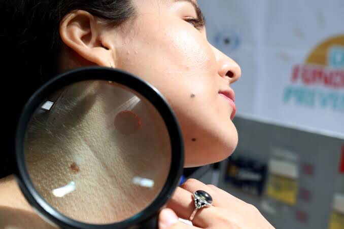 Piura: campaña de detección de cáncer a la piel será hasta el 2 de febrero